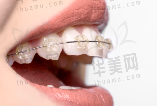 兰州诺贝尔口腔牙齿贴面情况