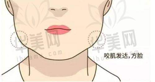 吸脂技术优势