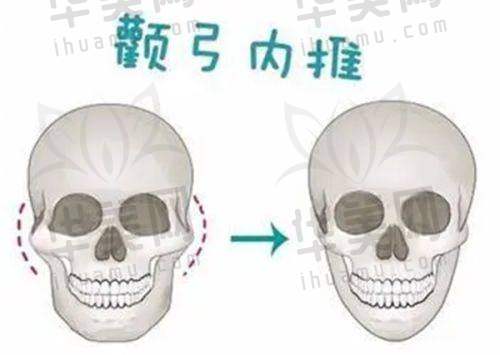 双眼皮项目特色